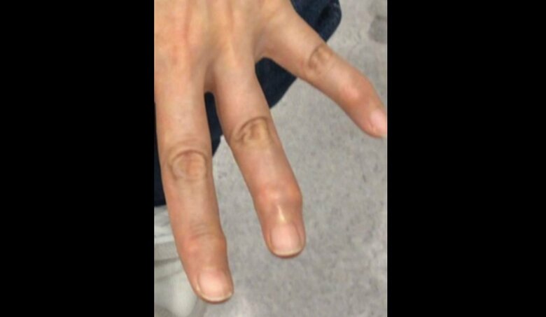 指の第一関節が腫れる「ヘバーデン結節」（提供：オクノクリニック銀座）