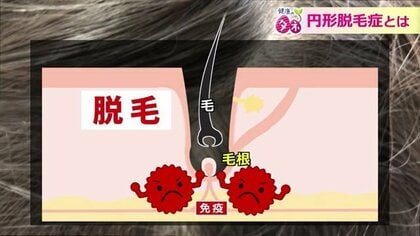 すべての髪が抜けることも…「円形脱毛症」がコロナ禍で増加　重要な早期治療【福井発】