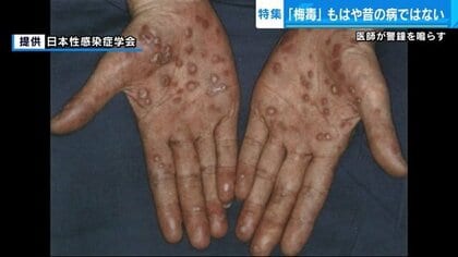 「梅毒」が急増 “誰もがかかりうる病気”に…症状がすぐに消えるため「治った」と勘違いして悪化も【広島発】