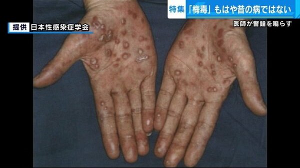 梅毒は妊娠にどのような影響を及ぼしますか?