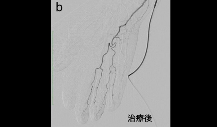 「動注治療」後の正常な血管に戻った指(提供:オクノクリニック銀座)