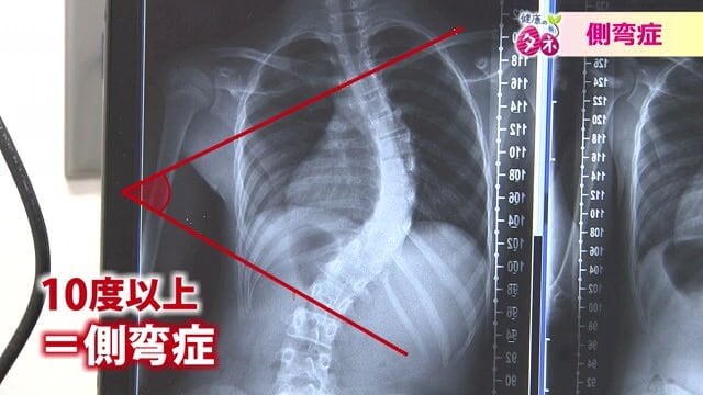 側弯症