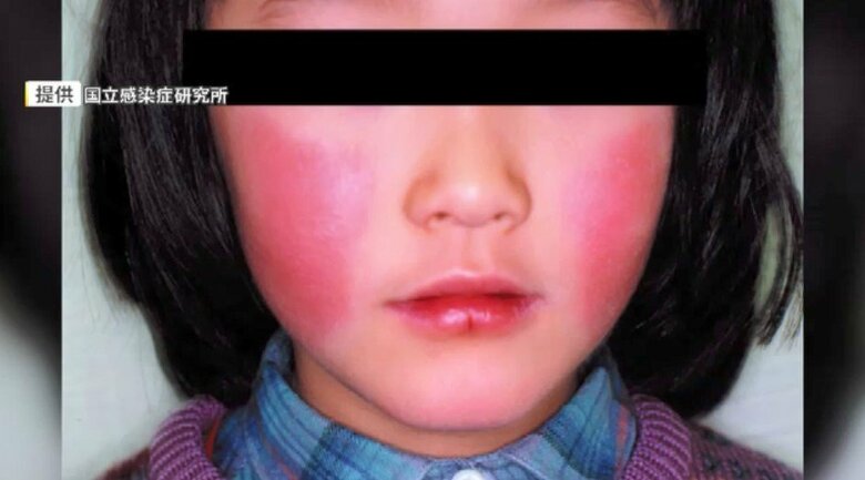 福岡県内の「百日ぜき」前週よりやや減少　一方で“りんご病”が増え前週の2倍超に　妊婦感染で胎児にリスクも｜FNNプライムオンライン