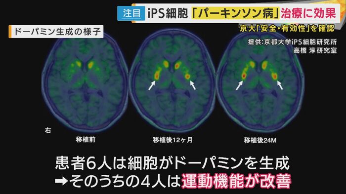 6人でドーパミン生成、4人は運動機能改善