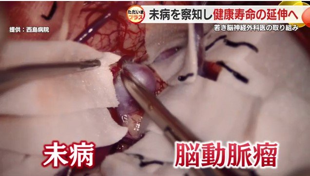 脳動脈瘤手術の様子（提供：西島病院）