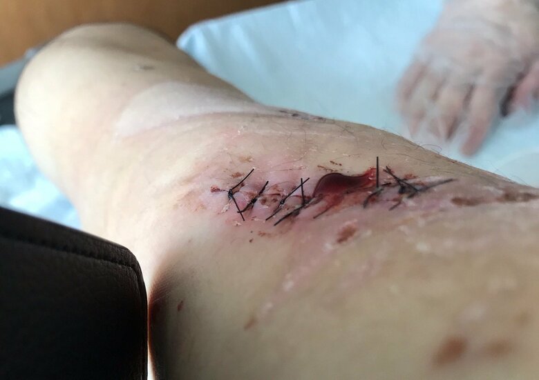 安藤さんの足のケガ。裂傷により全身140針を縫う大ケガを負った（本人提供）