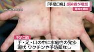 手足口病が2週連続で警報　感染113人、9割が2歳以下【佐賀県】
