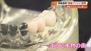 銀歯の悩みとお別れ！国内初開発、保険適用の白い樹脂製ブリッジ「シンボー」【高知】