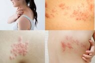 “失明”や“顔面まひ”も! 「帯状疱疹」がコロナ禍で急増 “4万円ワクチン”なら90%予防可能
