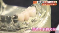 銀歯の悩みとお別れ！国内初開発、保険適用の白い樹脂製ブリッジ「シンボー」【高知】