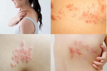 “失明”や“顔面まひ”も！　「帯状疱疹」がコロナ禍で急増　“4万円ワクチン”なら90％予防可能