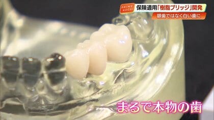 銀歯の悩みとお別れ！国内初開発、保険適用の白い樹脂製ブリッジ「シンボー」【高知】