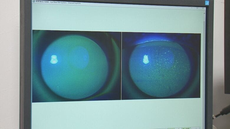 正常な角膜（左）／傷ついた角膜（右）