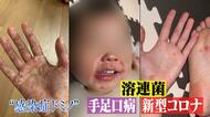 手足口病に溶連菌、新型コロナ…猛暑を襲う”警報級”感染症　家族が次々罹患する“感染症ドミノ”も発生　対策は？