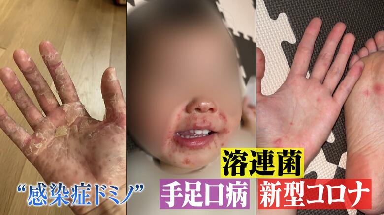 手足口病に溶連菌、新型コロナ…猛暑を襲う”警報級”感染症　家族が次々罹患する“感染症ドミノ”も発生　対策は？｜FNNプライムオンライン