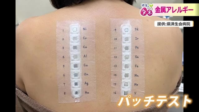 簡単な検査で原因となる金属を調べることができる