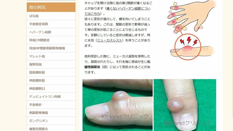 変形性指関節症の一種、へバーデン結節（田中医師の公式ウェブサイトより）