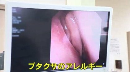 その症状「秋の花粉症」かも…医師「以前に比べ増えている」原因はブタクサなどの雑草　外遊びで花粉吸い込む子供も