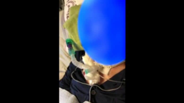 【速報】「親父の尊厳を守りたかった」　大阪公立大病院で骨折手術後に意識不明に　遺族が起こした裁判で医療過誤の責任認め病院に約4600万円の賠償命じる判決　「公表の遅れ」の訴えは退ける　大阪地裁｜FNNプライムオンライン