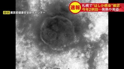 【速報】札幌で今年2例目のはしか感染確認＿インドから帰国の50代女性、発熱・発疹で13日に陽性判明…市保健所が予防接種と早期受診を呼びかけ感染拡大に警戒