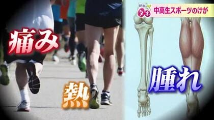 中高の新1年生は要注意…5月に増える“スポーツ外傷”　1回のプレーが原因で肉離れや靱帯損傷も　いますぐ自宅でできる予防法を紹介