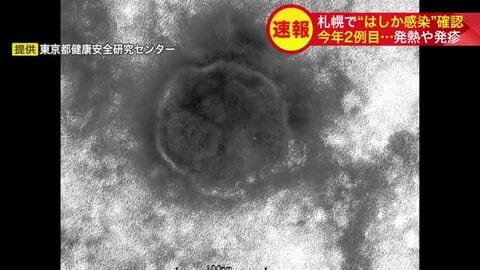 【速報】札幌で今年2例目のはしか感染確認＿インドから帰国の50代女性、発熱・発疹で13日に陽性判明…市保健所が予防接種と早期受診を呼びかけ感染拡大に警戒