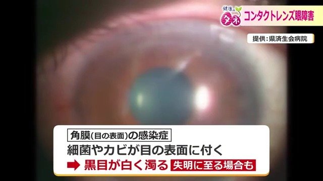 症状を放っておくと黒目がにごり失明の恐れも