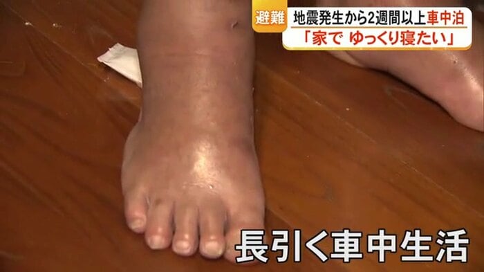 長引く車中生活でむくんだ田川さんの足