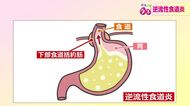 成人の約10～20％が発症する「逆流性食道炎」　食べ過ぎや早食いはリスクに　みぞおちの痛み、“口の中が酸っぱい”は要注意