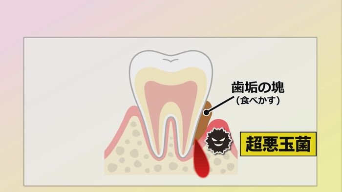 ヘミン鉄を取り込むことで超悪玉菌になる