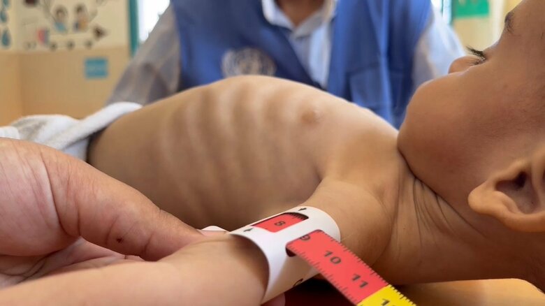 7カ月乳児の腕の太さが栄養失調のため8cmしかない