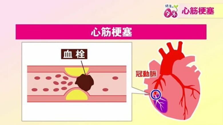 左肩や耳の後ろに痛みも…心筋梗塞の前兆　「時々たくさん飲む」飲酒スタイルは危険　専門医がリスク回避について解説｜FNNプライムオンライン