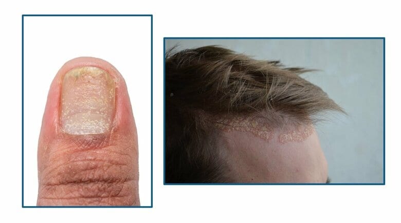 頭皮や爪にも症状が現れることも（画像：アムジェン株式会社）
