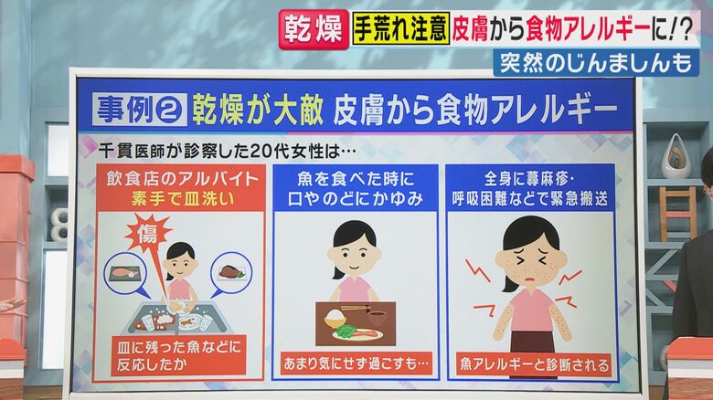 “素手の皿洗い”で発症（関西テレビ「旬感LIVE とれたてっ！」より）