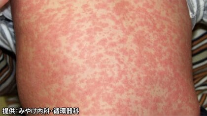 “空気感染”も起こる…愛知で20代女性2人の感染が判明した『はしか』の特徴と対策 合併症で死に至るケースも