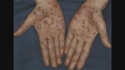 「過去の病」梅毒が現代を侵食 マッチングアプリ時代の落とし穴　感染急増の真相に迫る