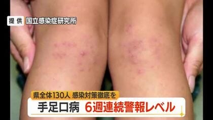 6週連続警報レベル・手足口病患者数130人（前週比+15人）　タオル共用避けこまめに手洗いを　山形