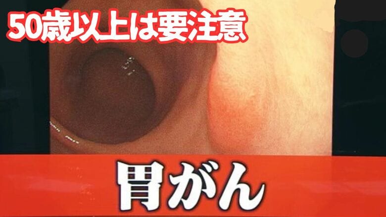 50代から死亡率が上昇する「胃がん」　加齢でリスク高まるピロリ菌感染　早期発見へ“医師おすすめ”は内視鏡検査｜FNNプライムオンライン