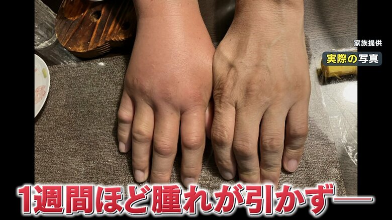 ハチに刺された右手が大きく腫れ上がっている