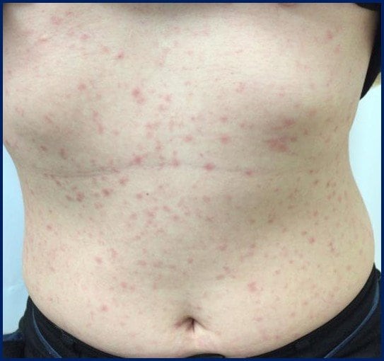 腹部に出た「バラ疹」症状