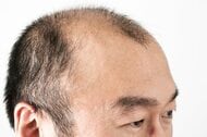 AGA発症には「母方の祖父」の薄毛が影響大　父親がフサフサでも油断できない…「母方の曽祖父」も薄毛でさらに高確率に