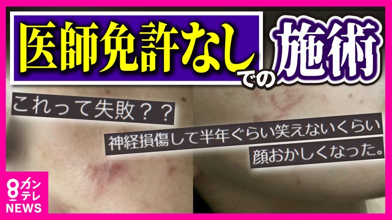 「医師免許なしでの施術は『医師法違反』」　切らないたるみ治療「HIFU（ハイフ）」で“やけど”　美容医療トラブル増加で厚労省が通知｜FNNプライムオンライン