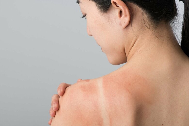 ”災害級の暑さ”で日焼けトラブル続出。皮膚科医が推奨する、コロナ禍で弱くなった肌を守る「日焼け対策」と「対処法」｜FNNプライムオンライン