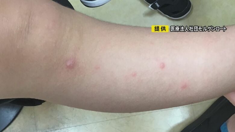 7月に続き2回目の流行…『手足口病』愛知と岐阜を含む35都府県で“警報レベル” 秋でも暑い日続いたことが一因か｜FNNプライムオンライン
