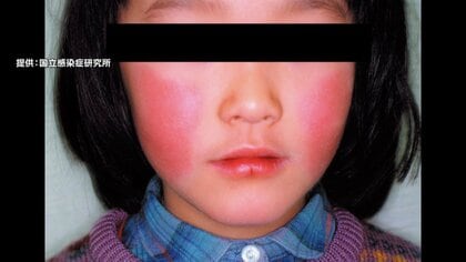 【感染拡大】「リンゴ病」患者数が増加　東京・埼玉で“警報レベル”超える　妊婦が感染すると流産することも　厚労省