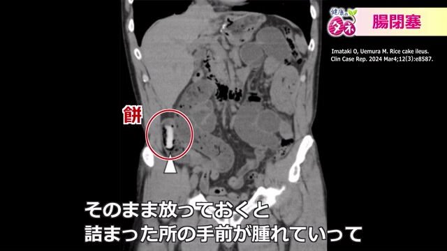 餅が腸につまり腸閉塞に