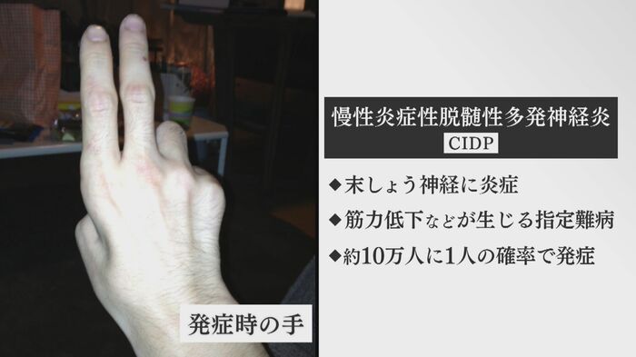 「慢性炎症性脱髄性多発神経炎」を発症