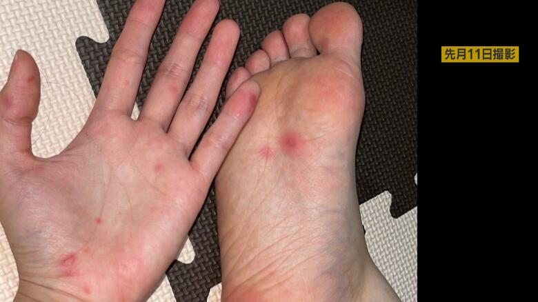 足の裏には、大きな赤い発疹が2つ