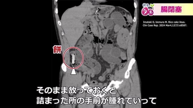 餅が腸につまり腸閉塞に