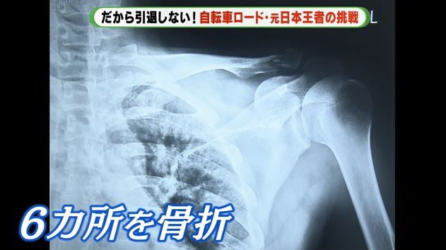 佐野選手のレントゲン写真　鎖骨やろっ骨など6カ所を骨折